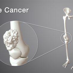Bone Cancer : Where It Starts