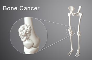 Bone Cancer : Where It Starts