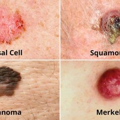 How Does Skin Cancer Start?