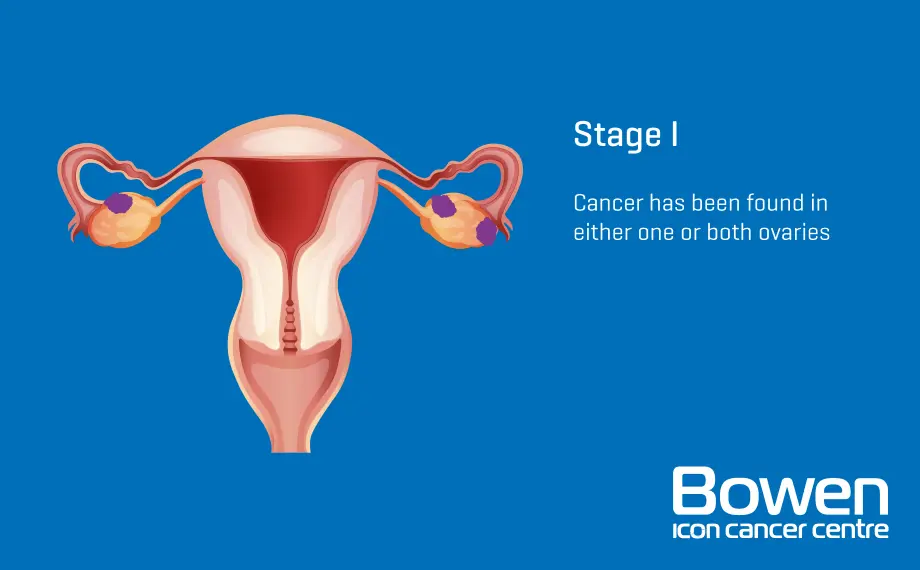 Can Stage 1 Cancer Spread?